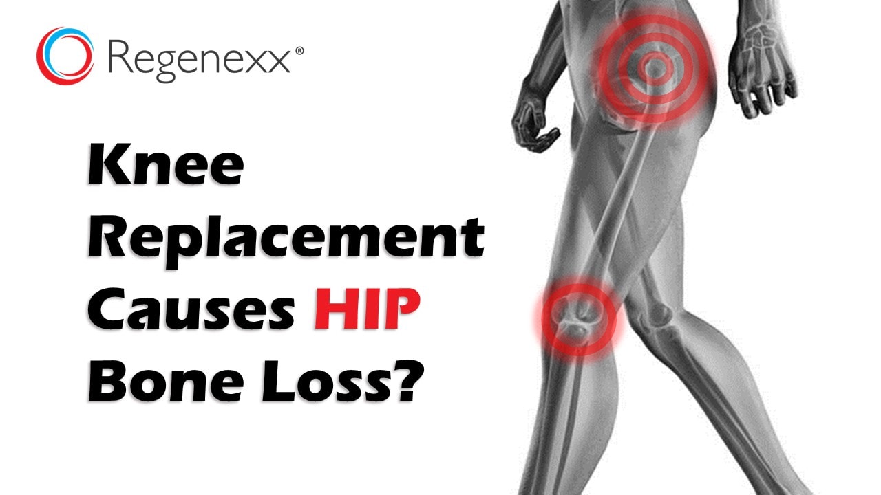 Why Are Hips Losing Bone After Knee Replacement Regenexx®