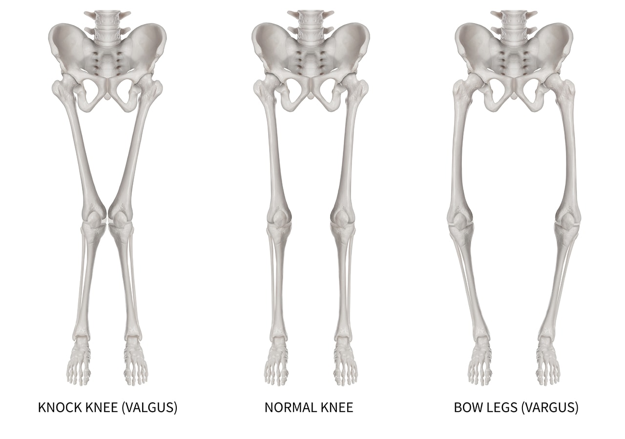 Can You Treat A Valgus Knee Without Surgery Regenexx