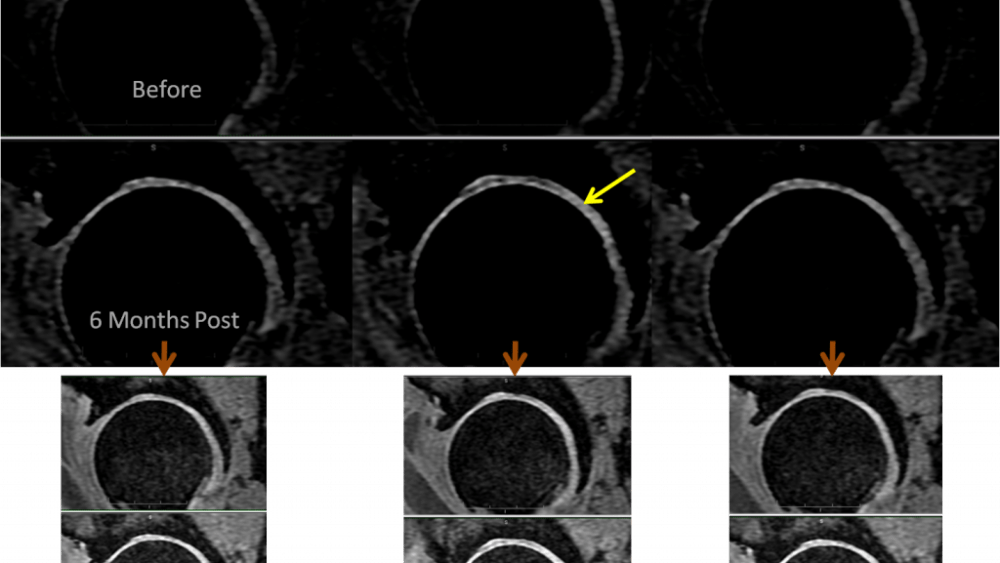 Making Cartilage Better on MRI