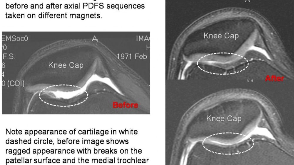 Treatments for knee cartilage lesions
