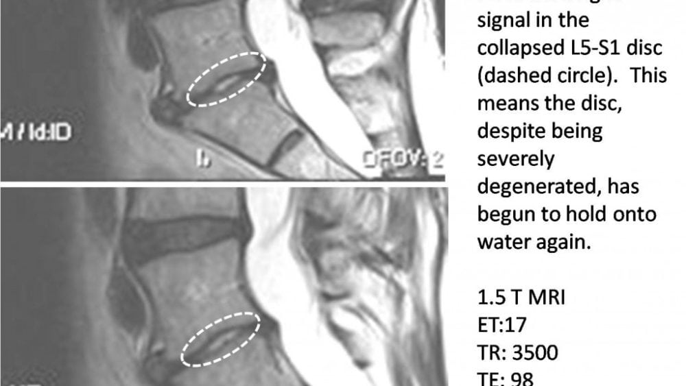 New Research on Stem Cells and Degenerated Discs