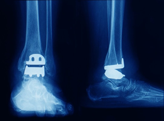 Anteroposterior and lateral foot and ankle x-ray showing total ankle replacement