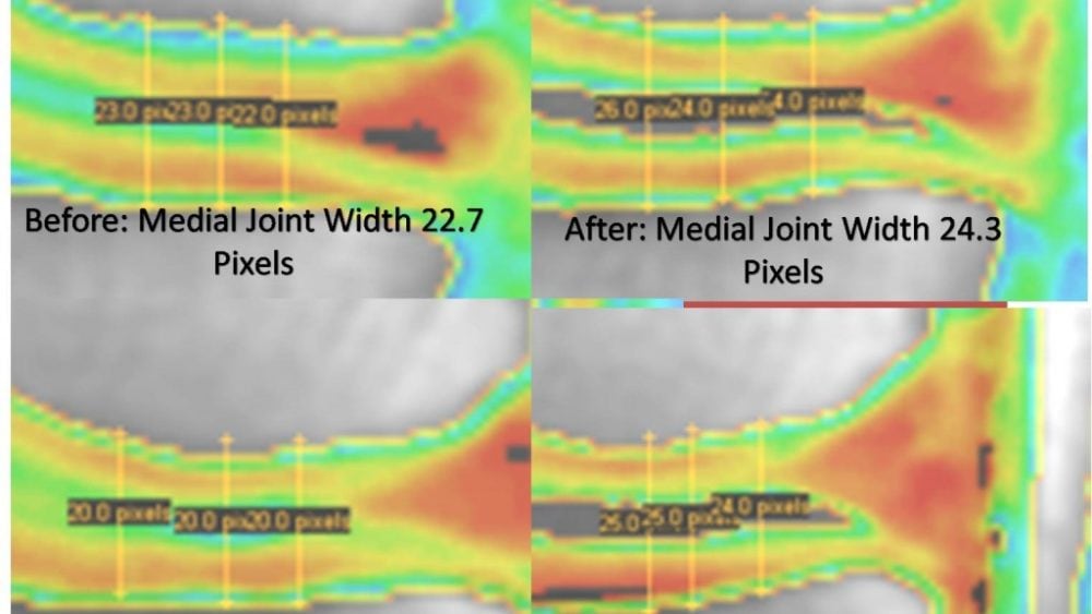 Increased Knee Joint Width after Stem Cells