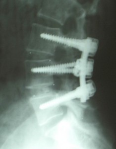 Spinal Fusion?