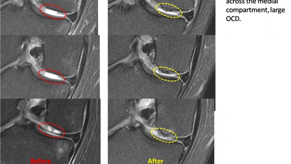 Regenexx vs. Micro Fracture