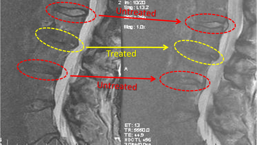 Mesenchymal Stem Cells Arrest the Progression of Degenerative Disc Disease