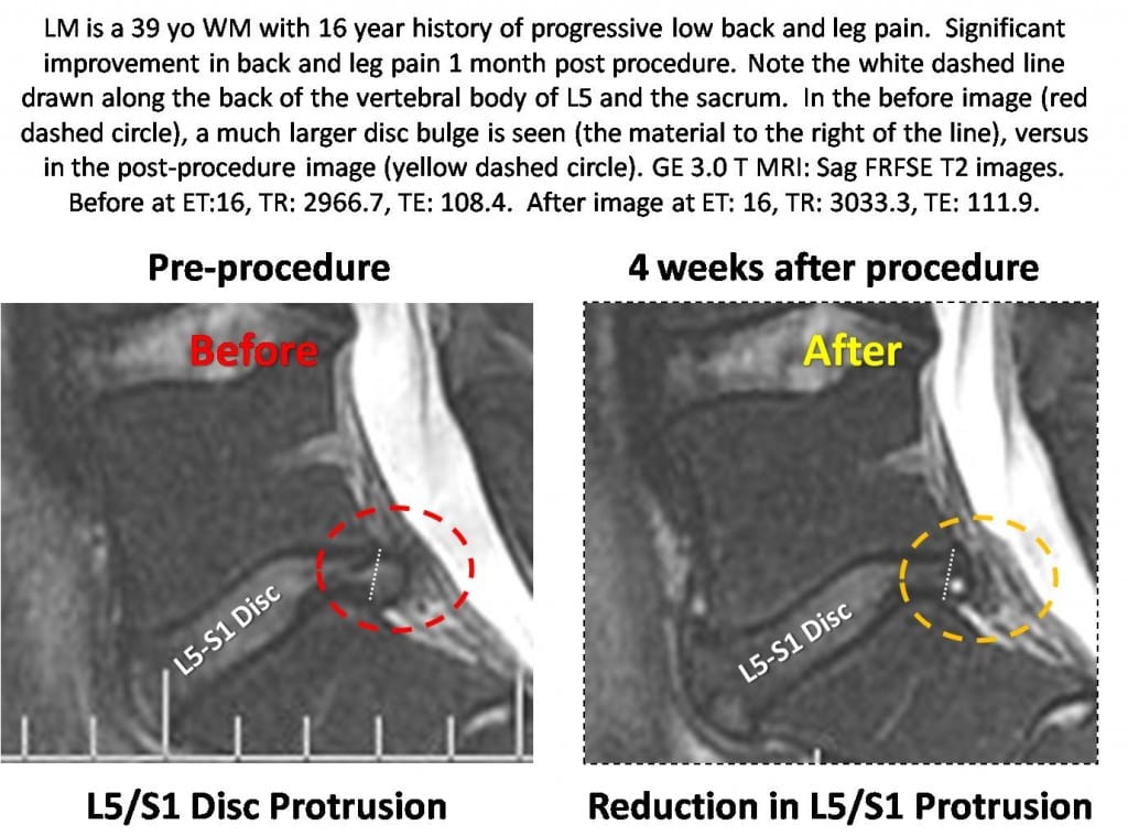 L5-S1 disc bulge treated without surgery with an injection of stem cells