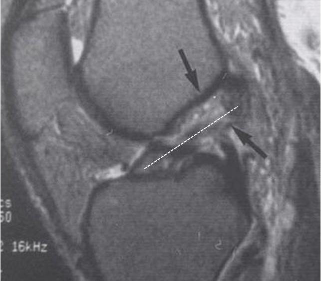 Full thickness ACL tear with meniscus damage…patient report of outcome.