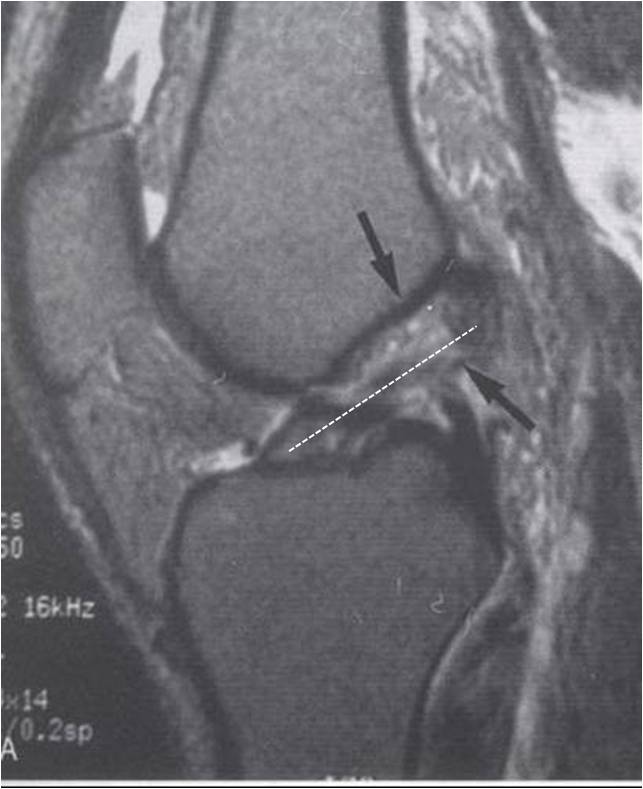 Treating Knee Acl Tears With Stem Cells, Not Surgery.