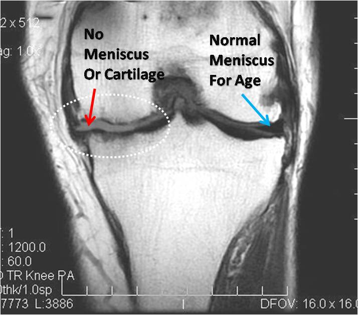 knee-kl-lost-meniscus1