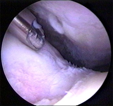 Knee surgery and the rate of cartilage loss…