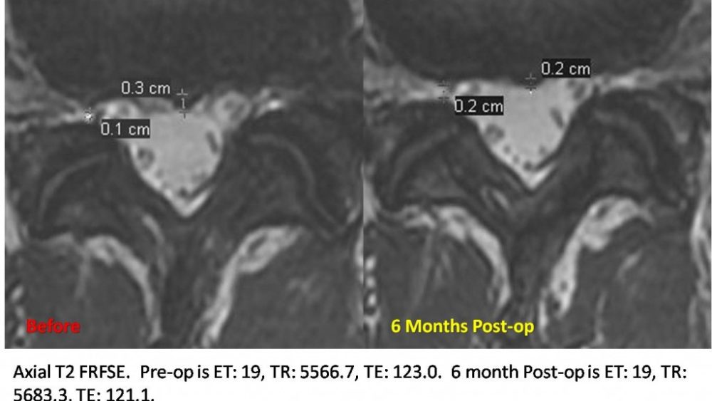Lumbar Disc Bulge treated with Stem Cell Injection: Imaging Case Report