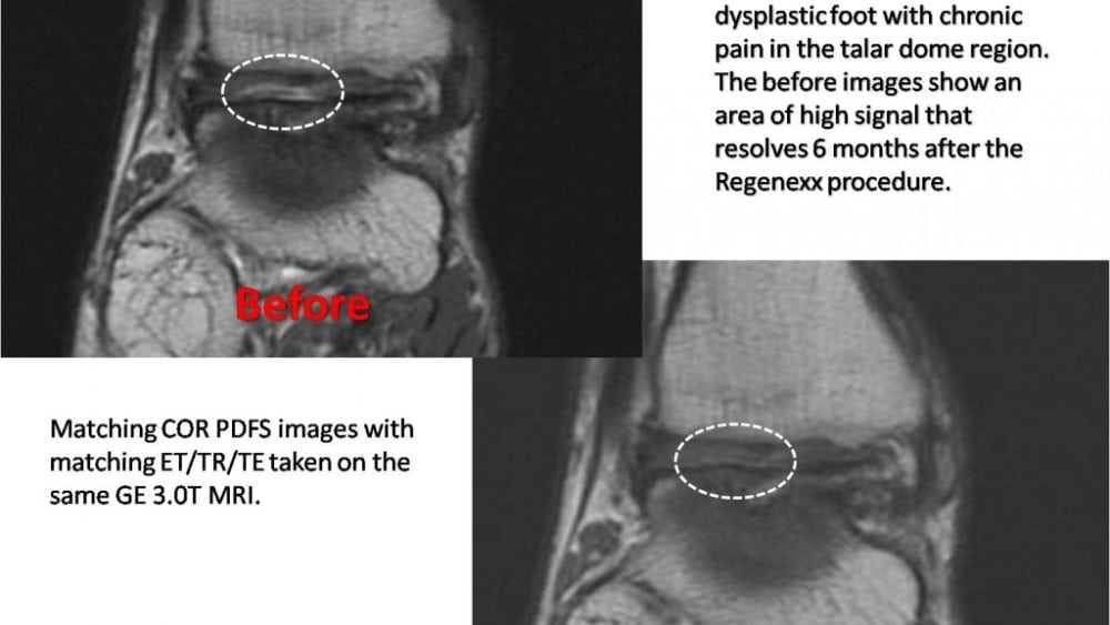 18 month follow-up on a patient with chronic ankle pain treated with stem cells…