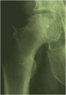 Hip AVN / ON (Avascular Necrosis – Osteonecrosis) Outcomes