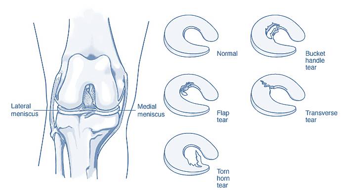 knee meniscus tear torn tore injection prp platelets stem cells