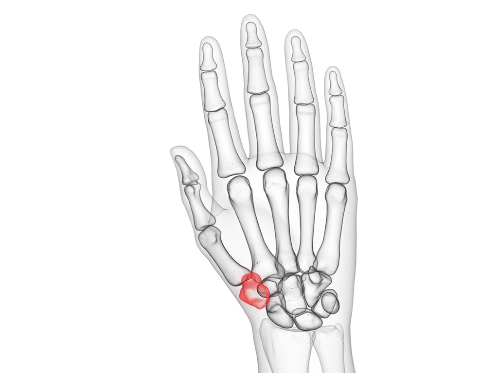 does-removing-the-trapezium-bone-help-thumb-arthritis