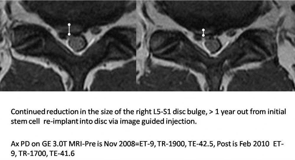 One Year Post Op on a Low Back Disc Bulge Treated with Stem Cell Injection