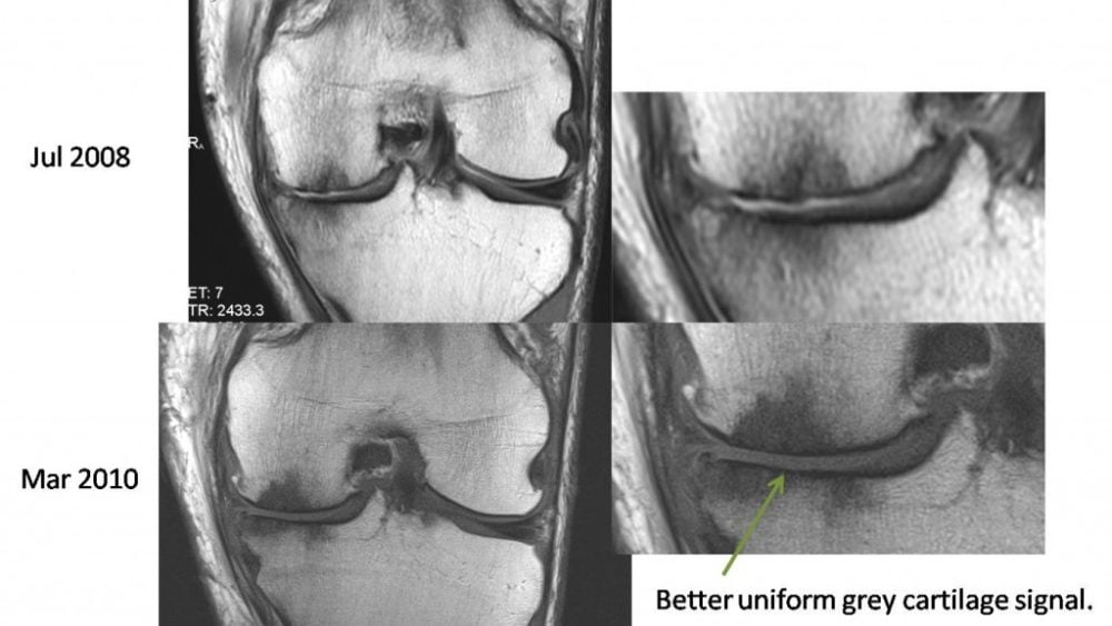 21 Month Follow-up on the Arthritic Knee of an Athlete Treated with Stem Cells Instead of Knee Replacement