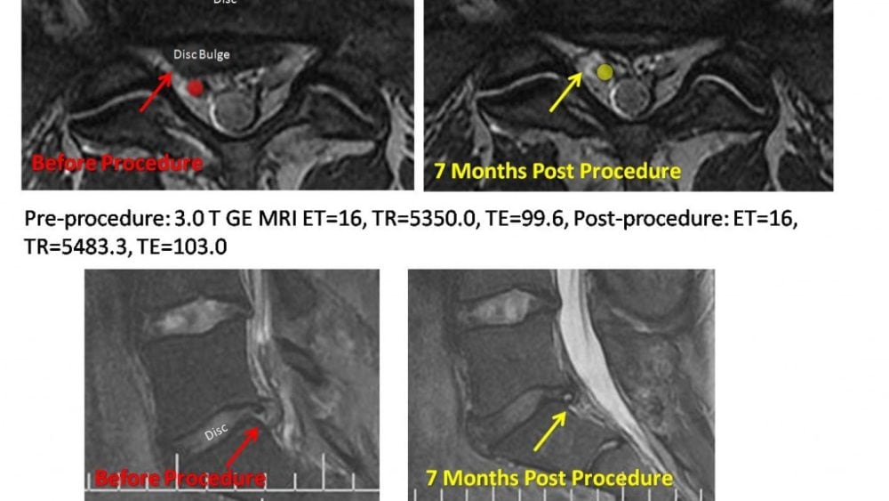 Dramatic Reduction in Disc Bulge with Disc Stem Cell Injection