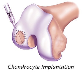 Stem Cells better than Knee Autologous Chondrocyte Implantation (ACI)