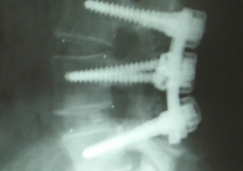 The Risks of Low Back Fusion