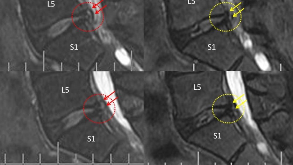 More stem cell disc successes…