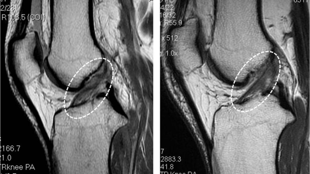 Prolotherapy helps patient avoid the need for ACL replacement surgery