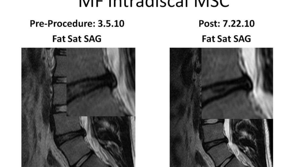 Stem Cells used to Treat a Disc Bulge-A Case of Some Improvement, but Additional Treatment Likely Needed