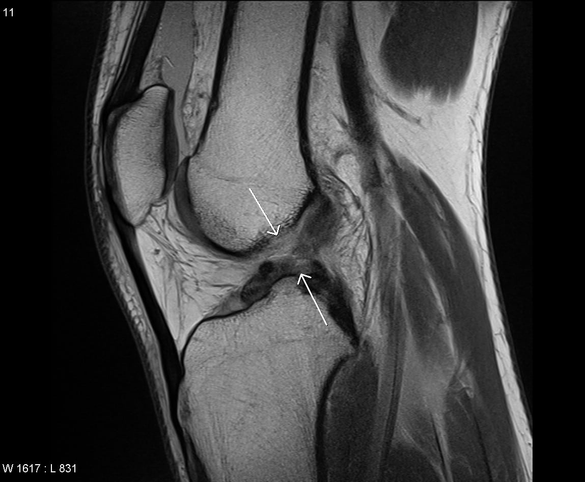 Acl partial tear surgery