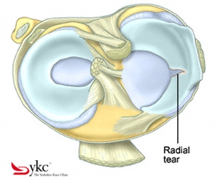 Radial Tear Of The Inside Knee Meniscus