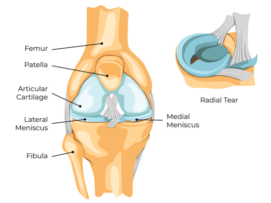 Medical illustration showing the anatomy of the knee with an inset of radial tear of the medial meniscus