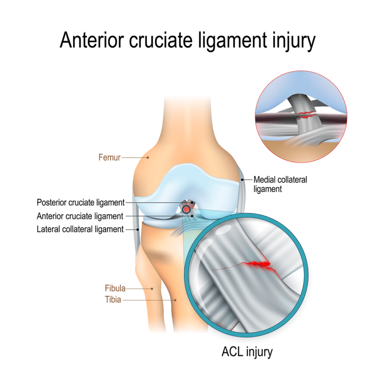 Treatment Of Loose And Stretched Acl With Stem Cell Injection