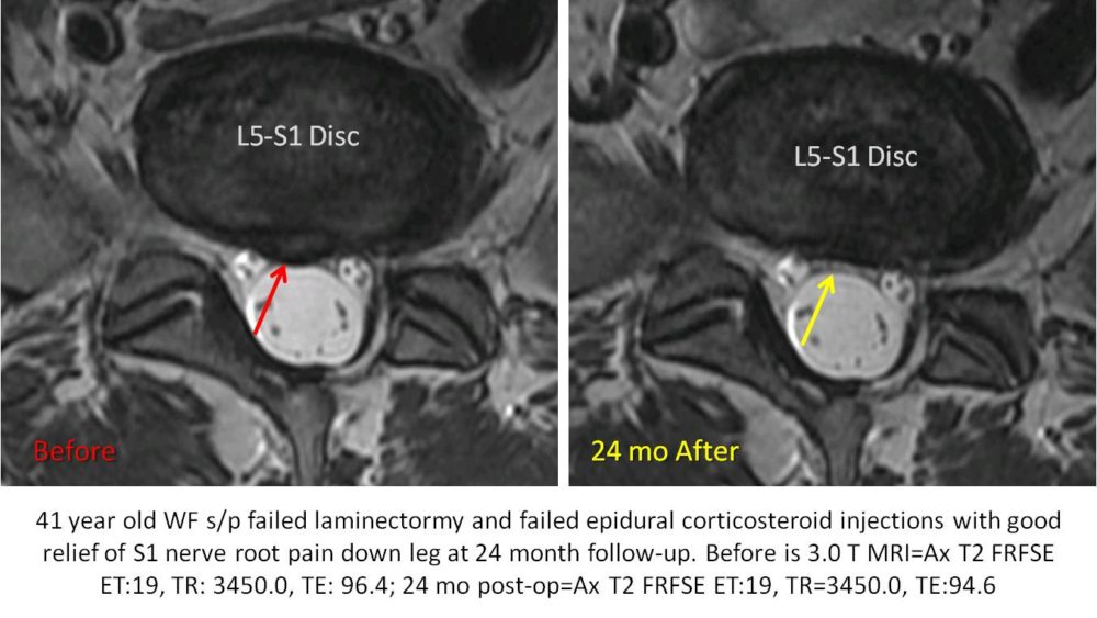Another 2 year Follow-up on Stem Cells Injected into a Disc Bulge