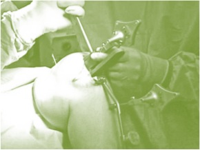 How Risky is Total Knee Replacement Surgery?