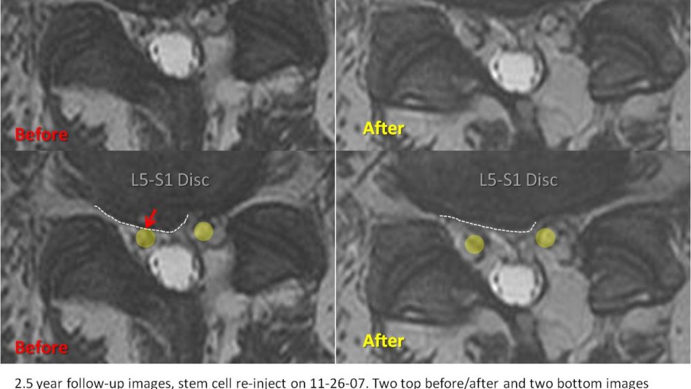 Long-term Follow-up on Injecting Stem Cells into a Disc