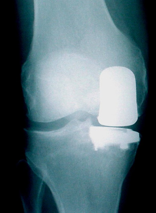 Regenexx-SD Knee Stem Cell Testimonial
