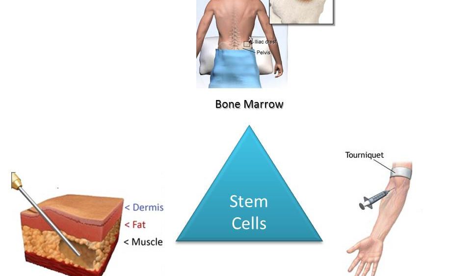Having Many Stem Cell Sources in the Toolbox benefits the Patient