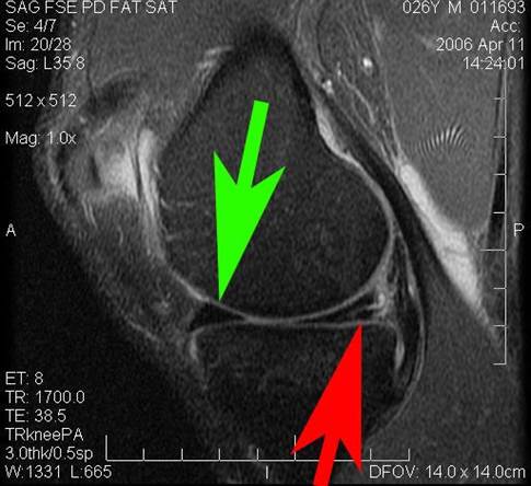 MRI Meniscus Tear Study Totally Misses the Point-Most Meniscus Tears