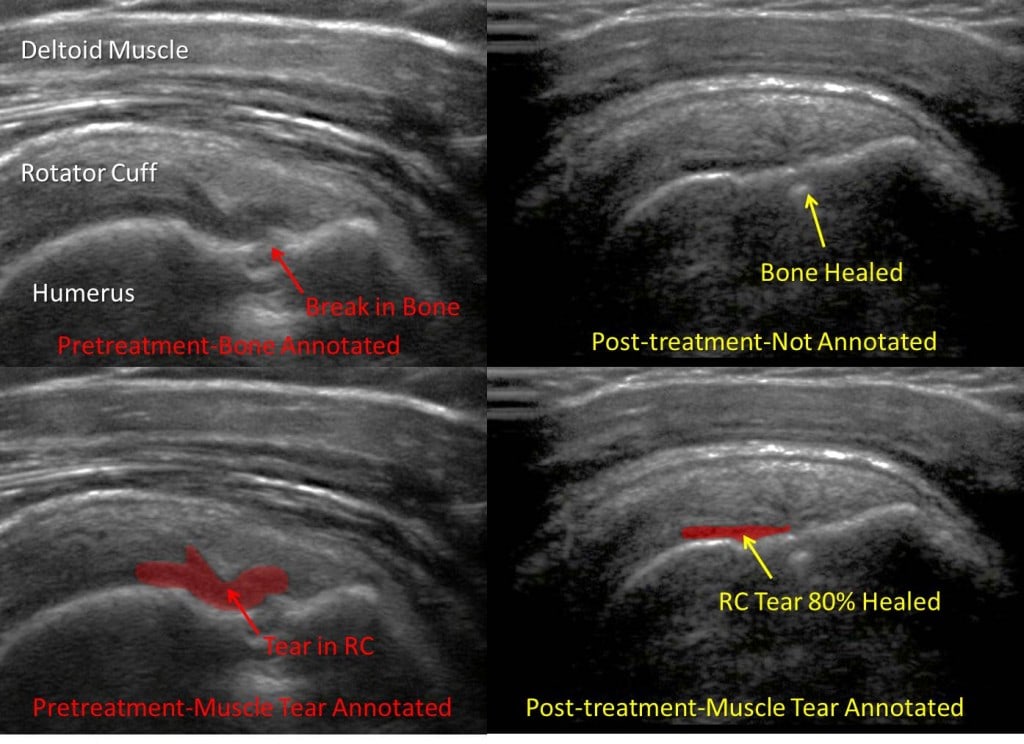 Healing a Shoulder Rotator Cuff Tear in a Physical Therapist with Stem