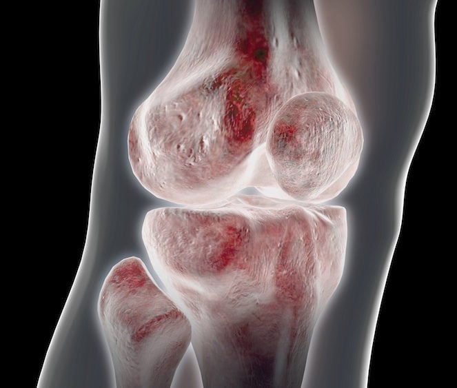 Removing parts of the Meniscus and Knee Arthritis: More Research Raises further Concerns