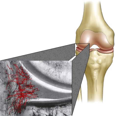 The Evidence behind Knee Meniscus Surgery