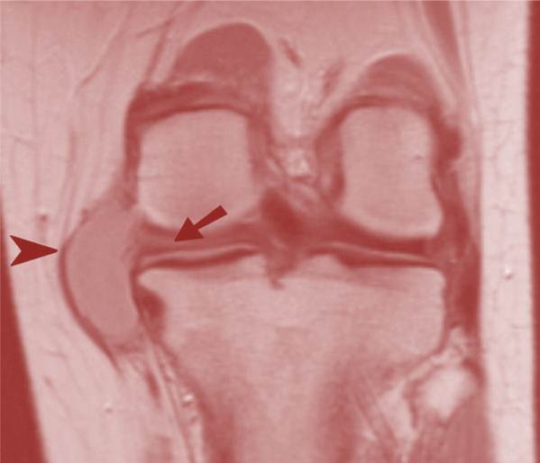 Knee Meniscus Tears associated with Meniscal Cysts