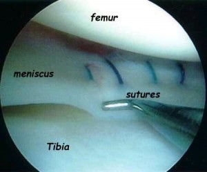 60% of Meniscectomies Result in Arthritis Within a Few Years of Removing Parts of the Meniscus with Surgery