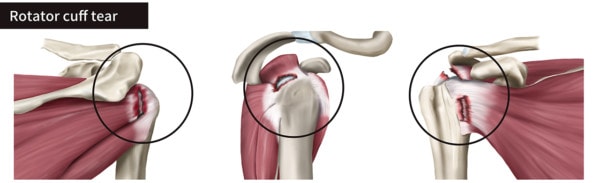 Medical illustration showing rotator cuff tears of the shoulder