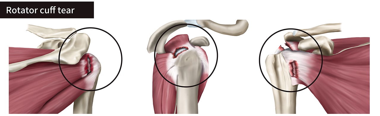 nonsurgical treatment for rotator cuff tears
