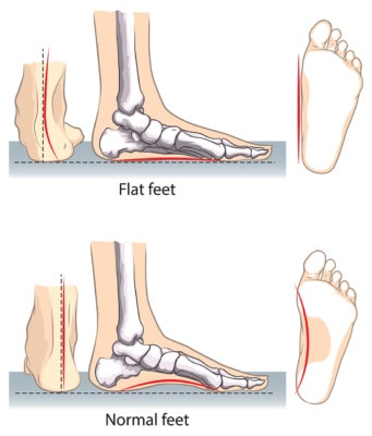 Medical infographic comparing a flat foot to a normal foor
