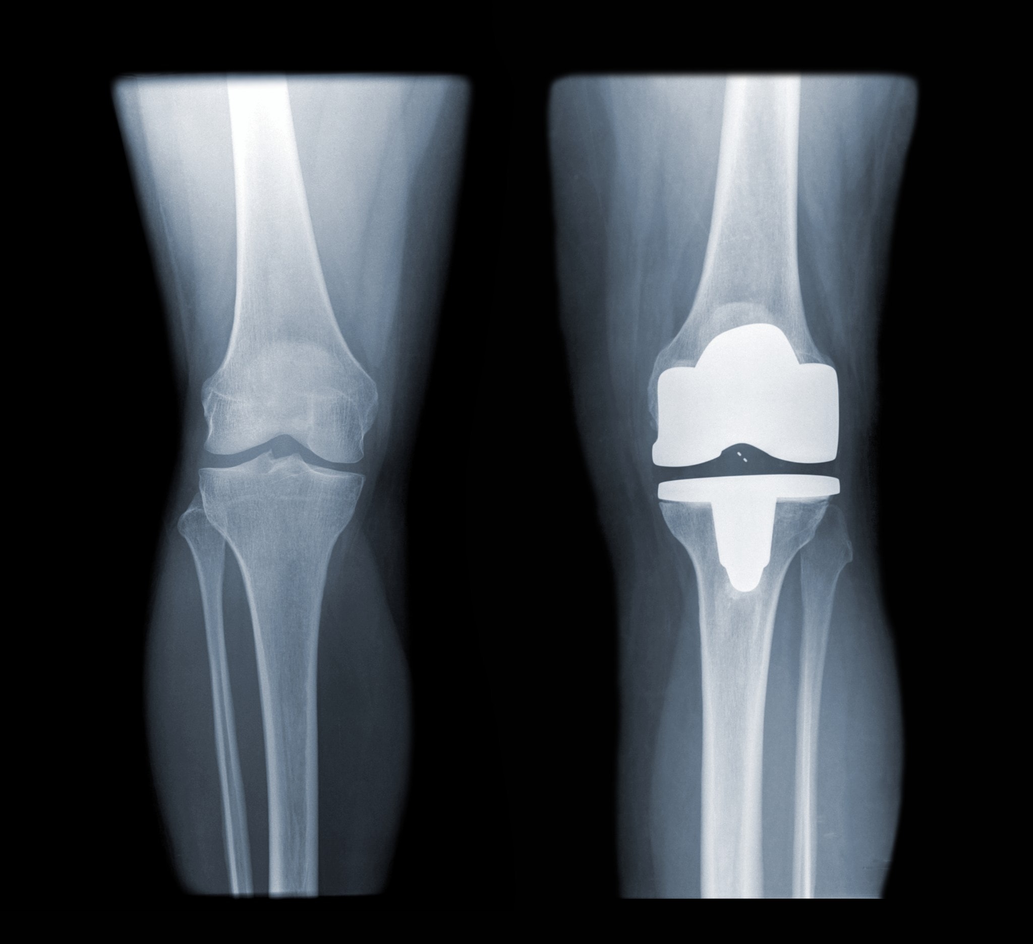 Операция по замене сустава на ноге. Эндопротезирование коленного сустава. Артроз коленного сустава эндопротез. Артропластика коленного. Эндопротез коленного сустава.