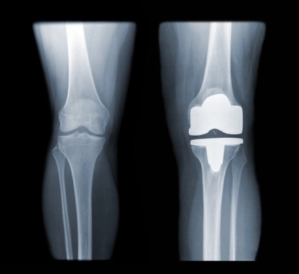 X-ray showing a healthy knee an a knee replacement