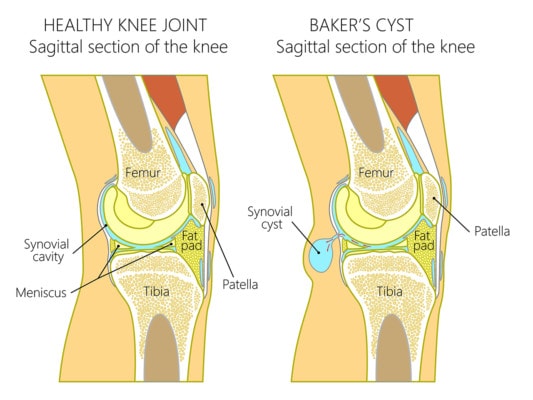 Medical illustration showing a healthy knee and a knee with a Baker's cyst