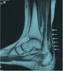 Surgical Repair of Achilles Tendon: No Better than No Surgery